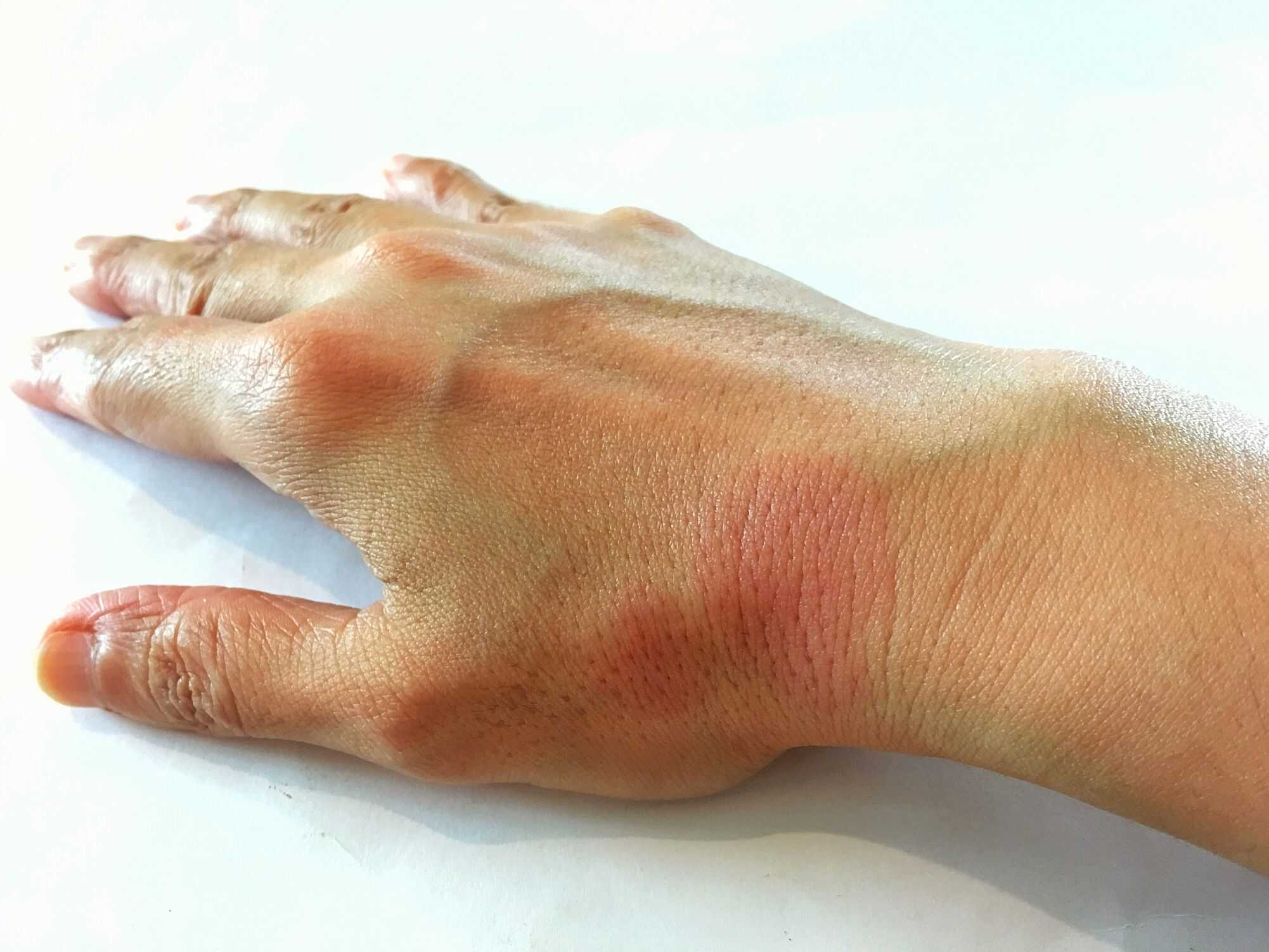 Vírus Epstein-Barr pode desencadear lúpus em milhões de pessoas